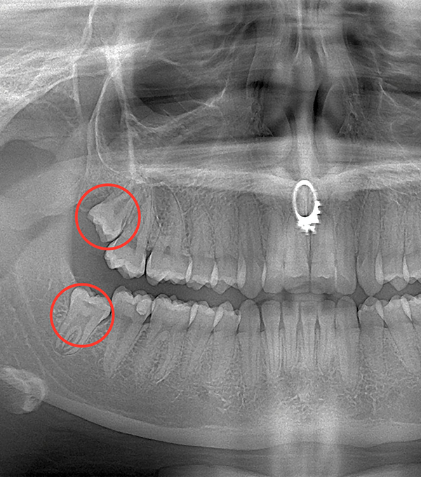 Dentes Siso